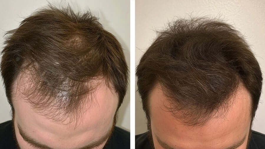 Avant/après utilisation du Growband Pro