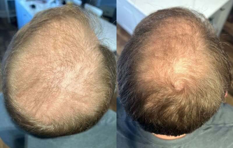 Photo avant/après utilisation du Growband Pro